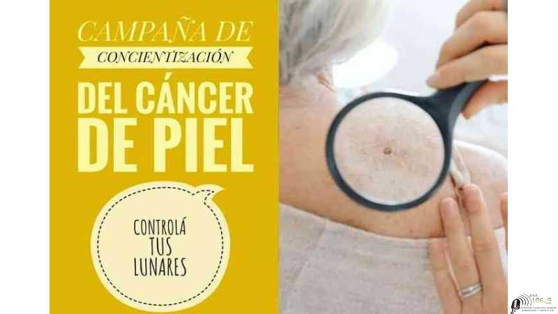 ALCEC ESPERANZA inicia la campaña de control de manchas y lunares, prevención del cancer de piel