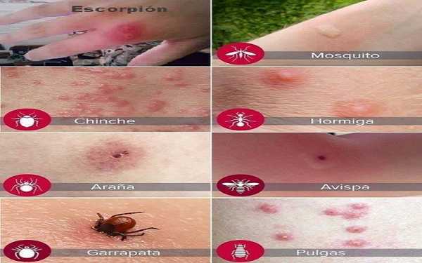Importante que todos sepamos el aspecto de las picaduras 