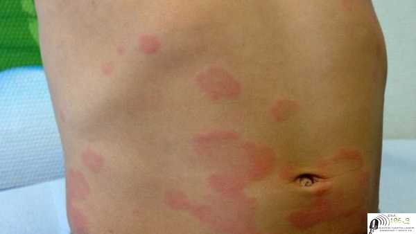 Un nuevo problema sanitario inquieta a Rafaela y la región 